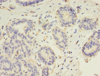 Immunohistochemistry of paraffin-embedded human breast cancer at dilution 1:100