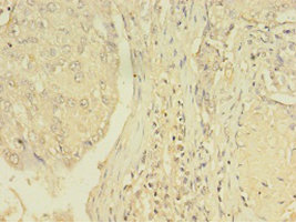 Immunohistochemistry of paraffin-embedded human lung cancer tissue at dilution 1:100