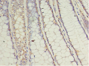 Immunohistochemistry of paraffin-embedded human colon cancer tissue at dilution 1:100