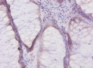 Immunohistochemistry of paraffin-embeded human colorectal carcinoma at dilution of 1:50