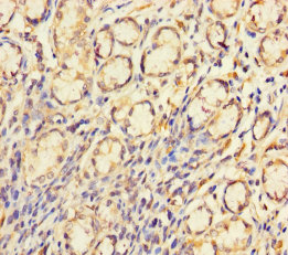 Immunohistochemistry of paraffin-embedded human gastric cancer at dilution of 1:100