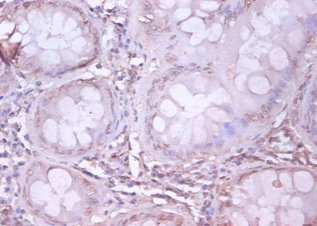 Immunohistochemistry of paraffin-embeded human colorectal carcinoma at dilution of 1:100