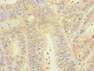 Immunohistochemistry of paraffin-embedded human colon cancer at dilution of 1:100