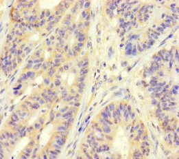 Immunohistochemistry of paraffin-embedded human colon cancer using MAPRE1 Polyclonal Antibody at dilution of 1:100