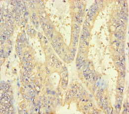 Immunohistochemistry of paraffin-embedded human endometrial cancer using INSL4 Polyclonal Antibody at dilution of 1:100