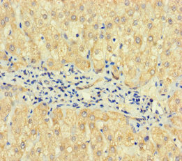 Immunohistochemistry of paraffin-embedded human liver cancer using TPTE2 Polyclonal Antibody at dilution of 1:100