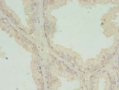 Immunohistochemistry of paraffin-embedded human prostate cancer using RQCD1 Polyclonal Antibody at dilution of 1:100